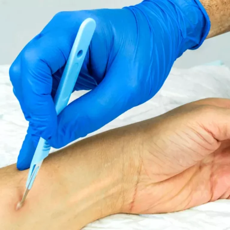 abscess-drainage-radiological-intervention