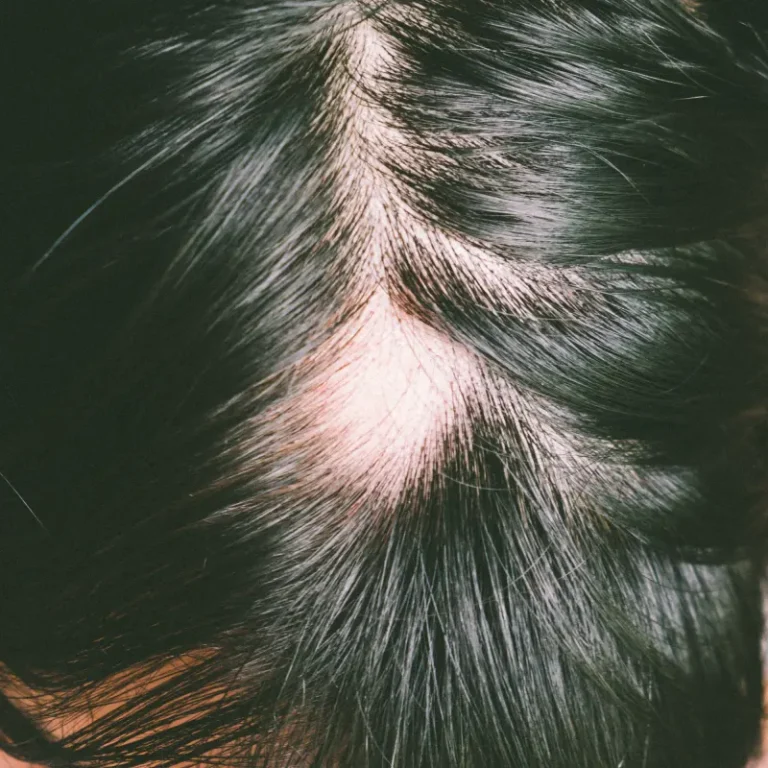 alopecia-treatment