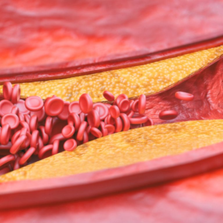 atherosclerosis-treatment
