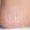 birthmark-removal