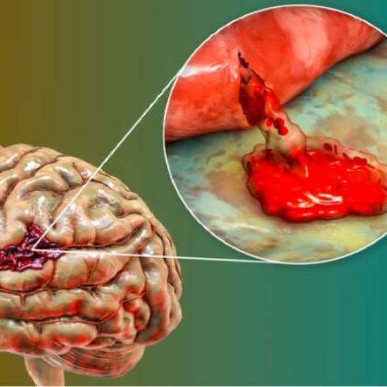 brain-hemorrhage-treatment