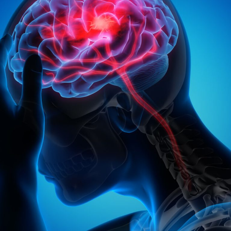 brain-stroke-treatment