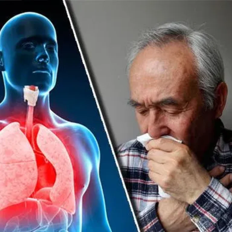 bronchitis-treatment