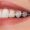 ceramic-braces