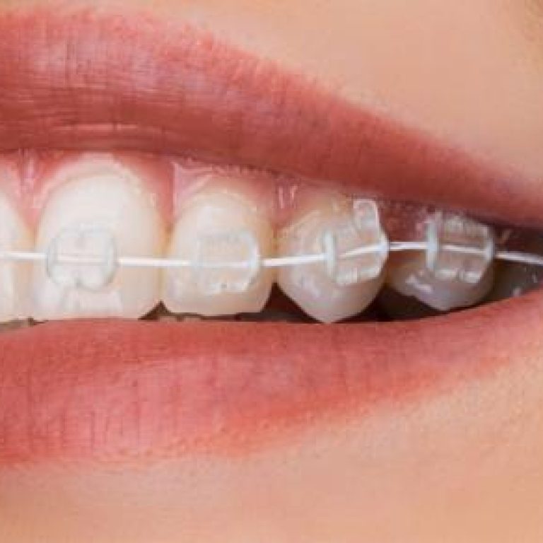ceramic-braces
