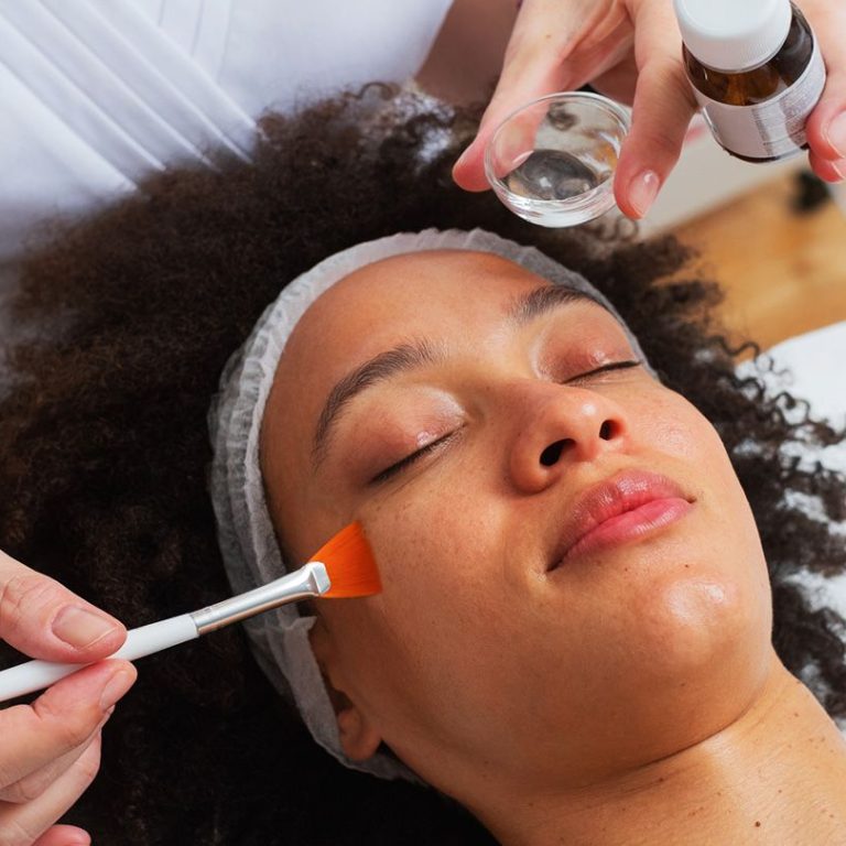 chemical-peel-treatment