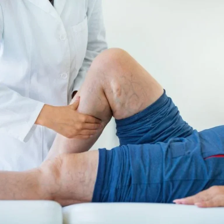 deep-vein-thrombosis-treatment