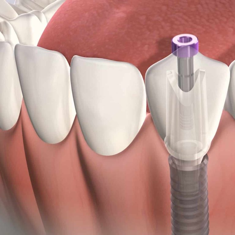 dental-implant