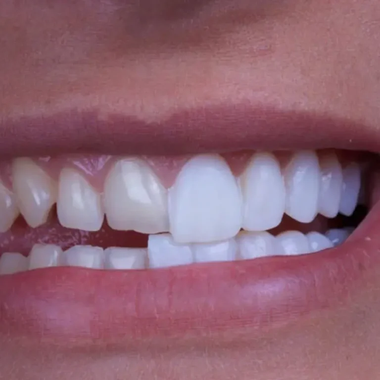 dental-veneers