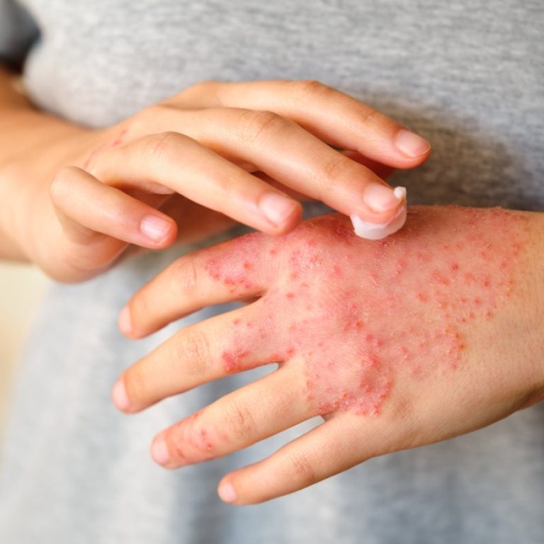 eczema-treatment