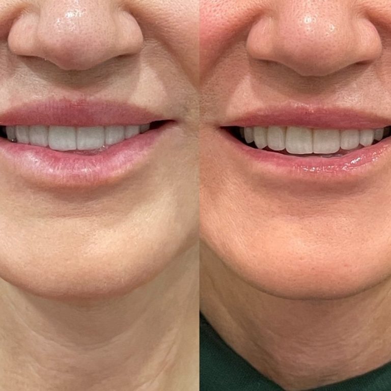 filler-dissolving-treatment