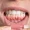 gum-depigmentation