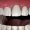 gum-resection