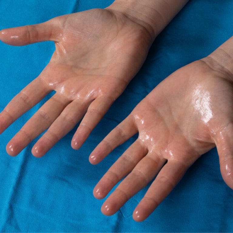 hyperhidrosis-treatment