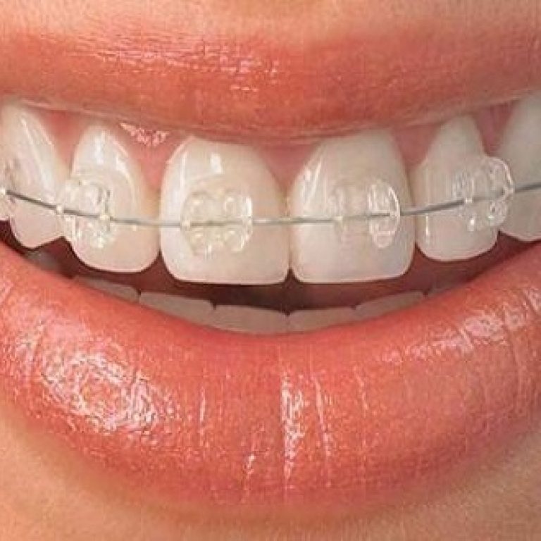 invisalign-clear-aligners