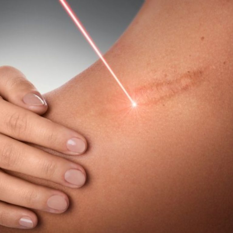 laser-scar-removal