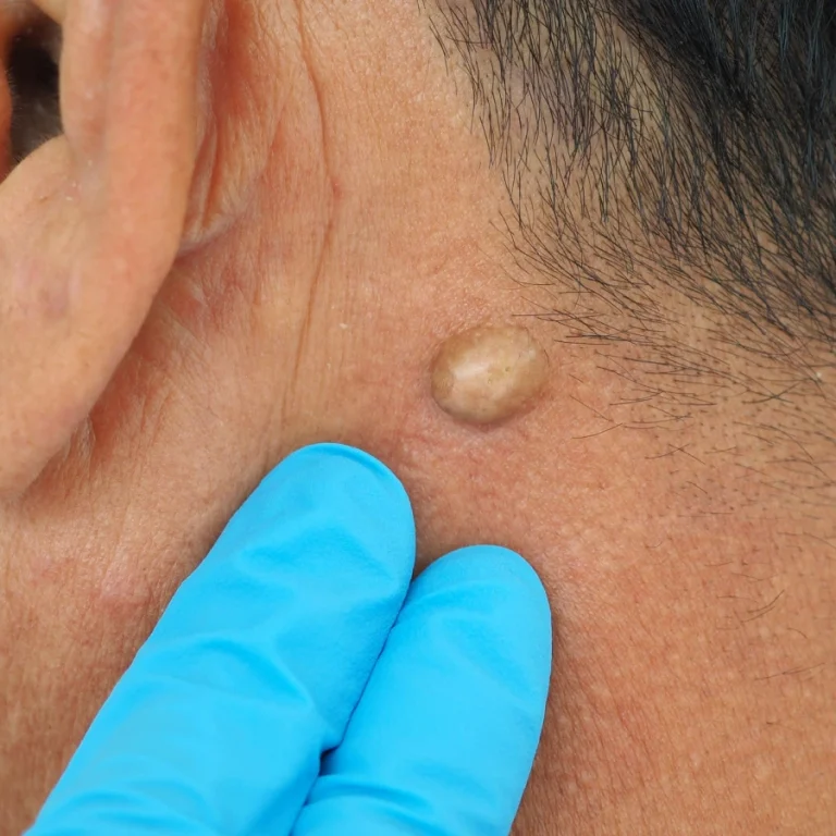 lipoma-removal-radiological-intervention