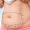 liposuction