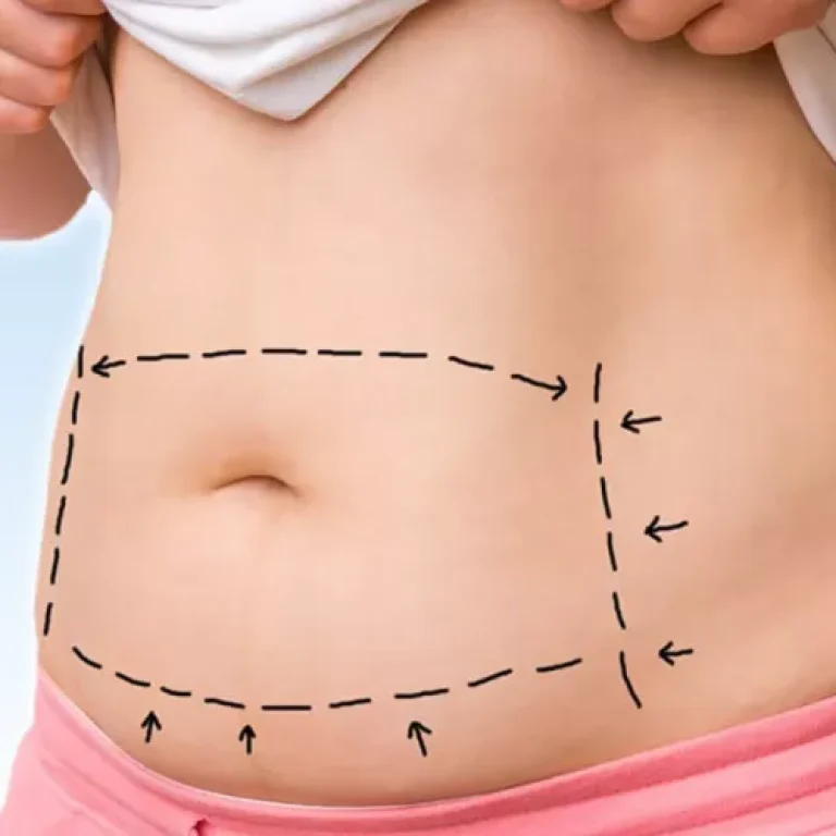 liposuction