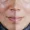 melasma-treatment