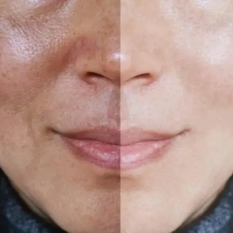 melasma-treatment