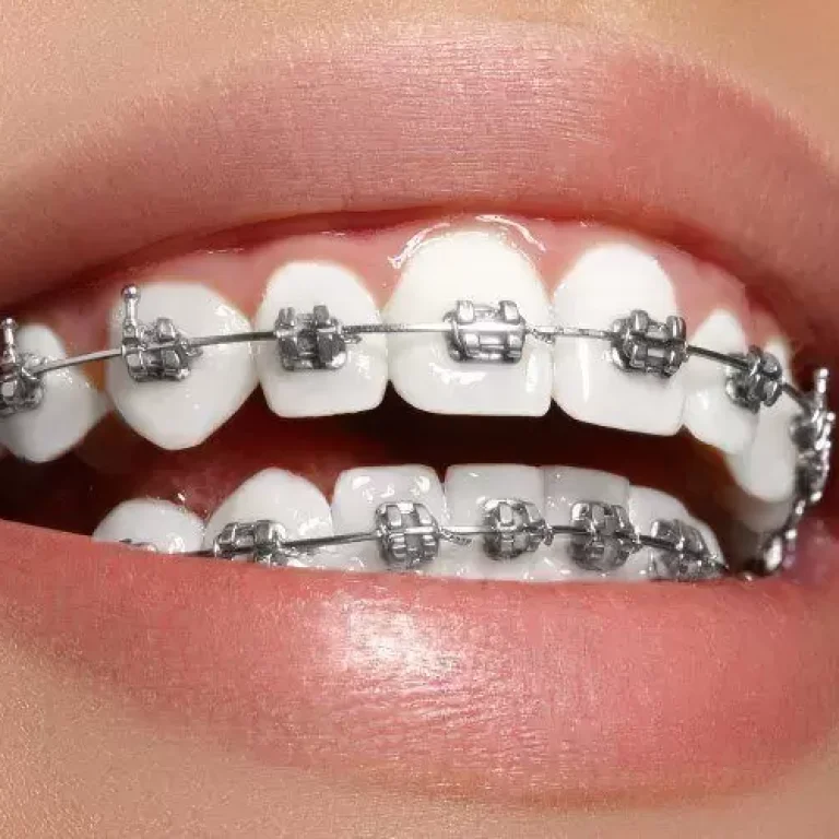 metal-braces