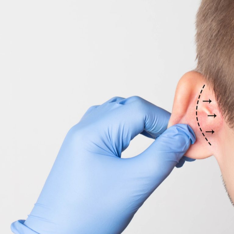 otoplasty-surgery