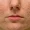 post-acne-scars-treatment