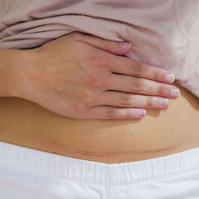 post-delivery-scar-repair