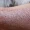psoriasis-treatment