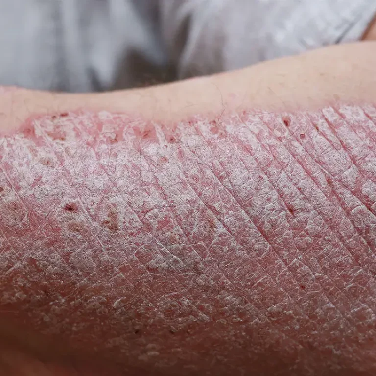 psoriasis-treatment
