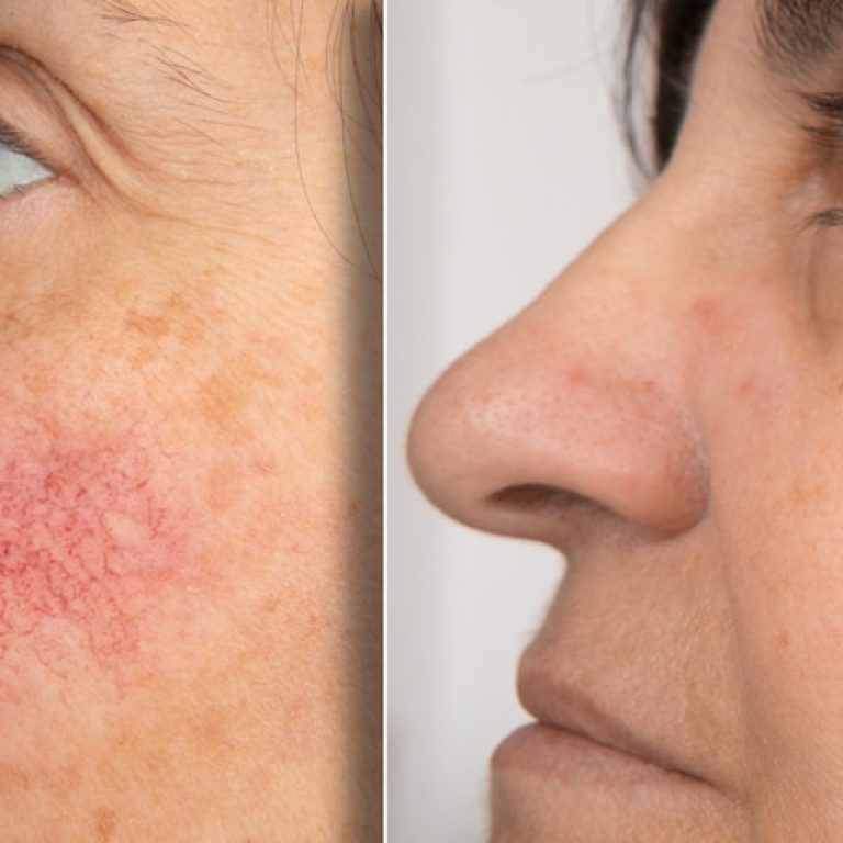 rosacea-treatment