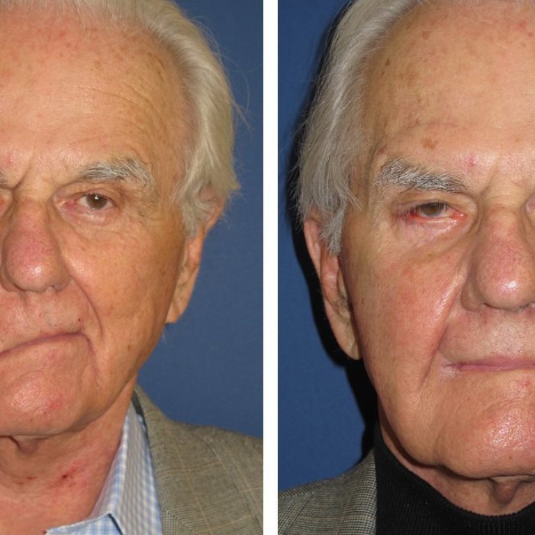 seventh-nerve-inflammation-treatment