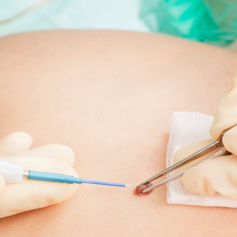 skin-lesion-excision