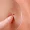 skin-tag-lipoma-removal