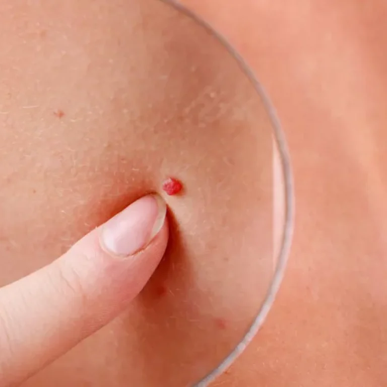 skin-tag-lipoma-removal