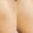 Close up of a young woman's thigh with white stretch marks from a weight loss or weight gain before and after laser removal procedure. Result of treatment. Cosmetology, beauty