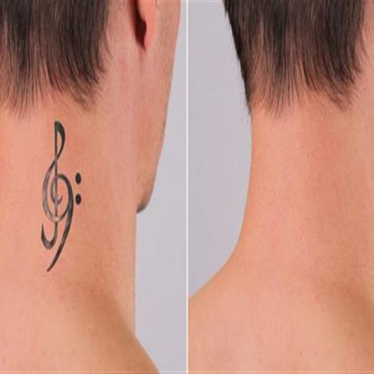 tattoo-removal
