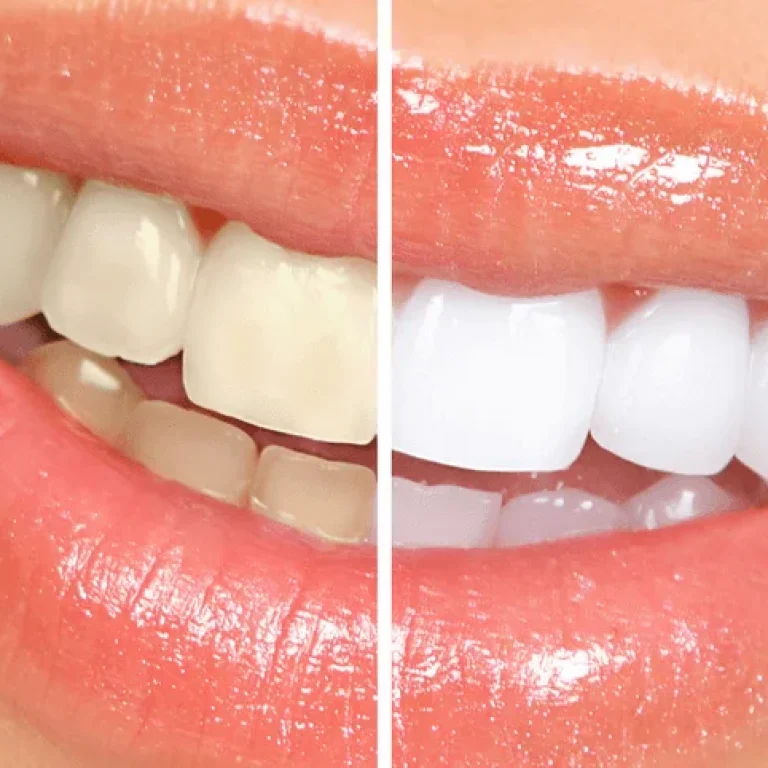 teeth-whitening