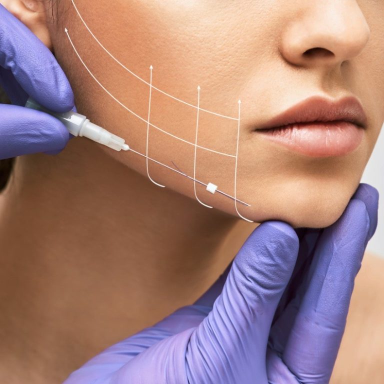 thread-lift-treatment