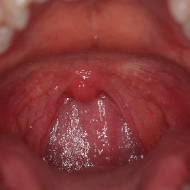 tonsillitis-treatment