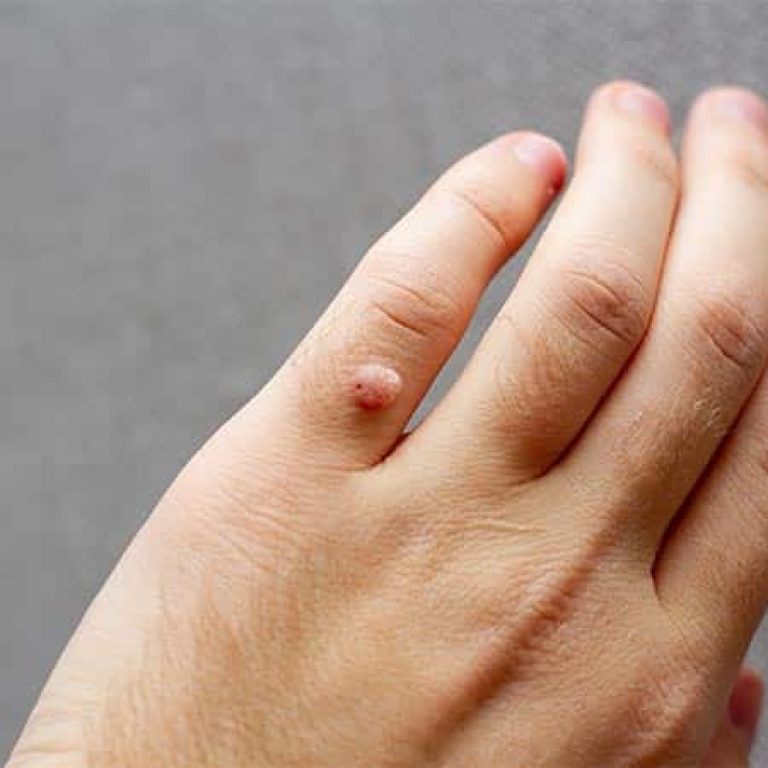 wart-removal